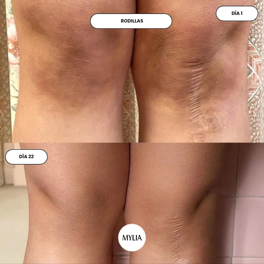 It evens out skin tone and visibly reduces persistent dark spot. - Mylia Care